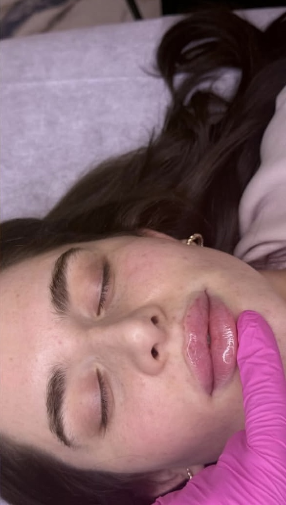 Lips after treatment
